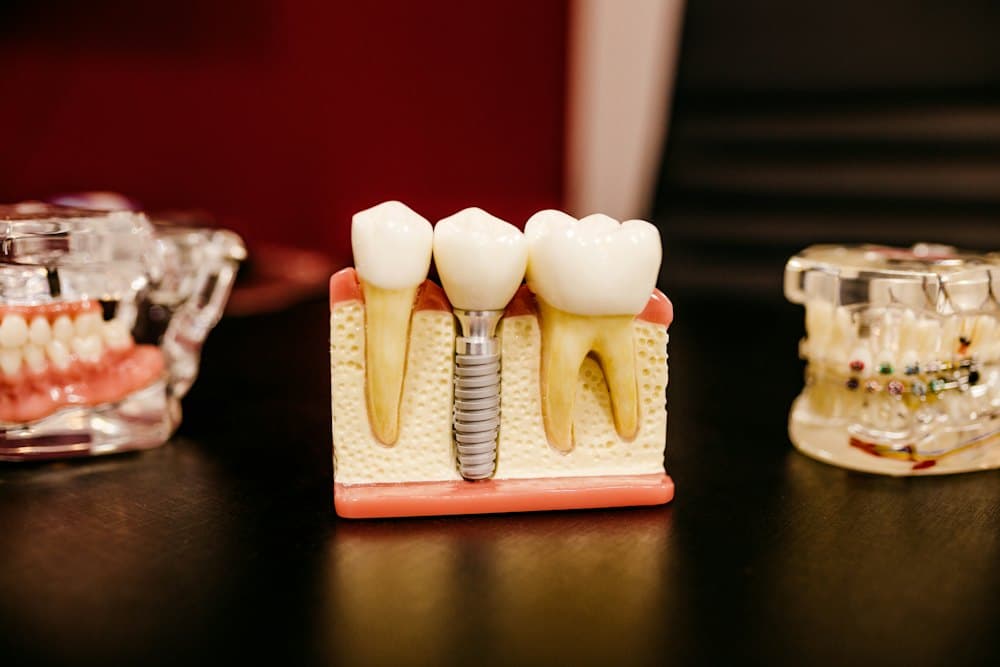 Mô hình trụ implant đặt giữa hai răng thật